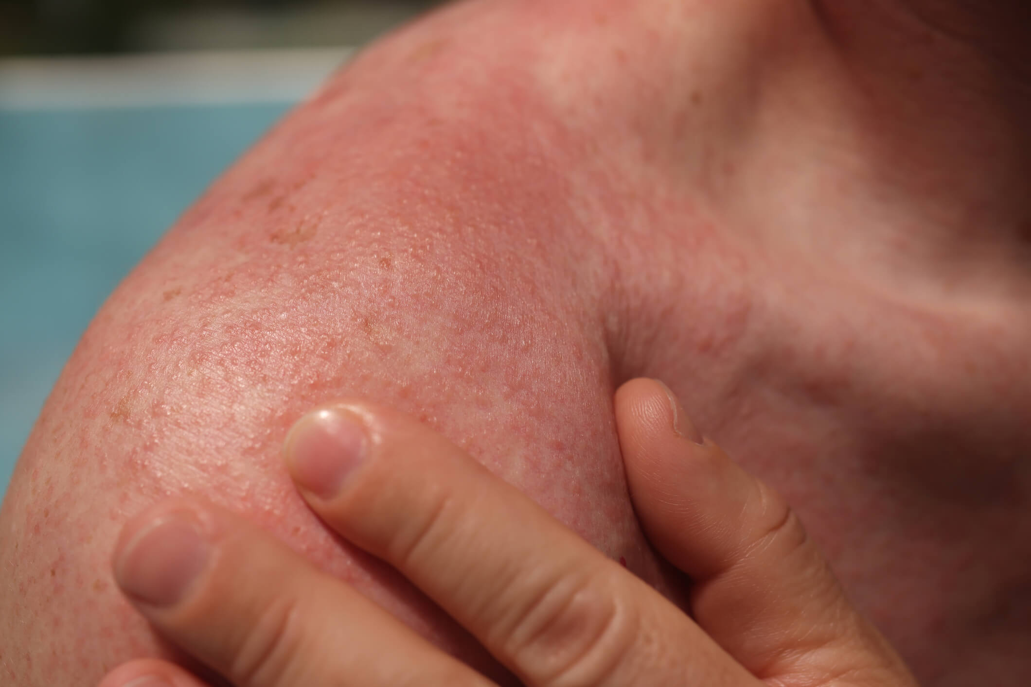 Close-up of patient's skin.