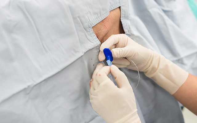 Administering a spinal catheter