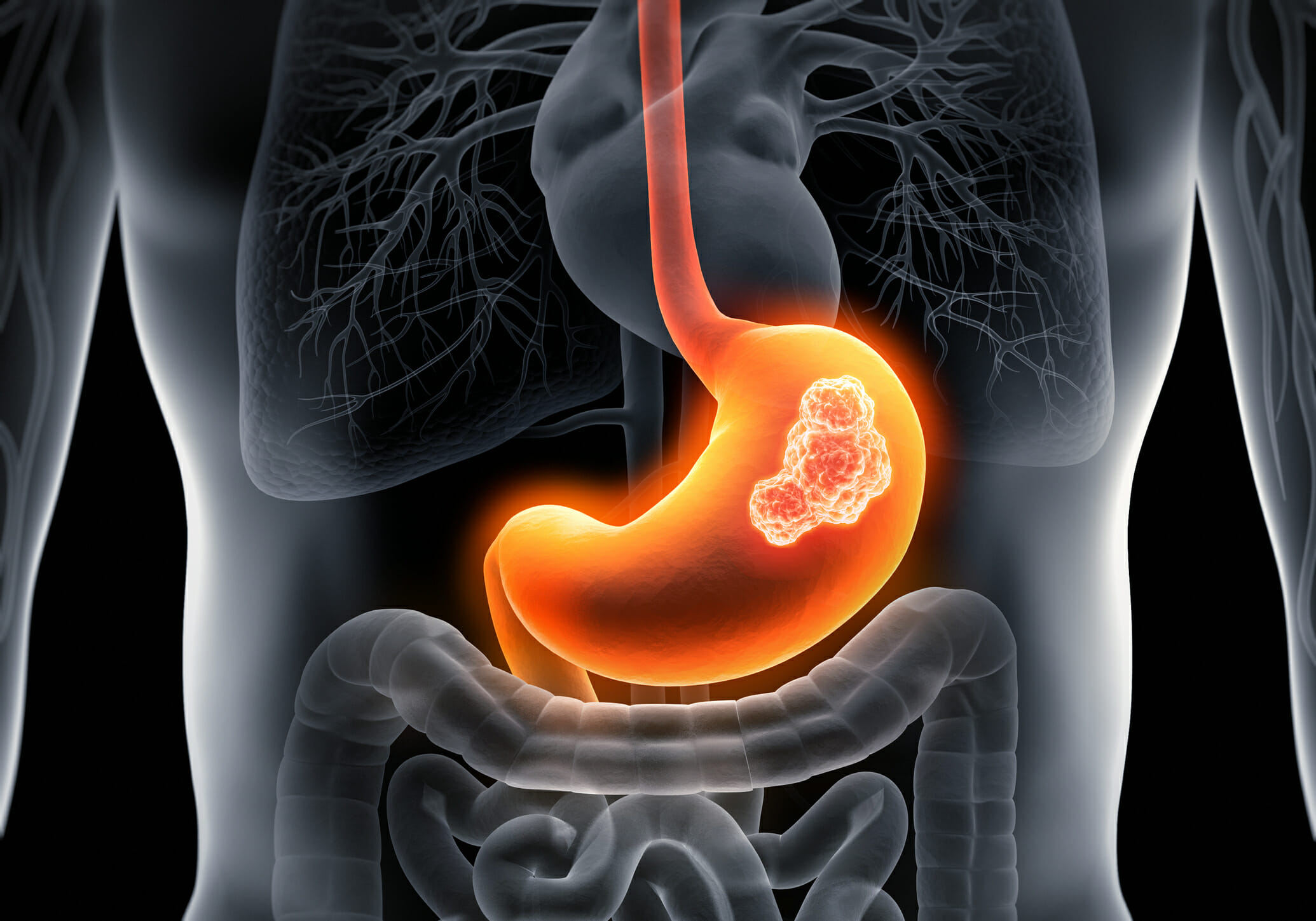 Gastric cancer