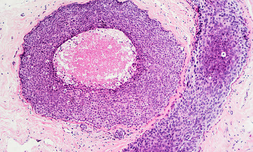 Many agents are in ongoing trials, and may provide additional options for patients with metastatic H