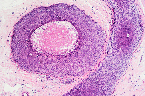 Many agents are in ongoing trials, and may provide additional options for patients with metastatic H