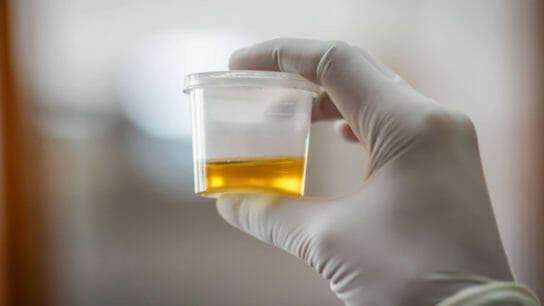 urinalysis urine lab test