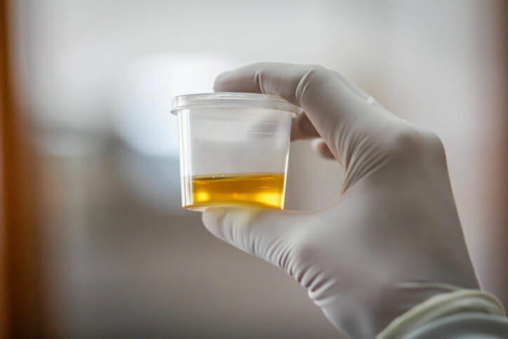 urinalysis urine lab test