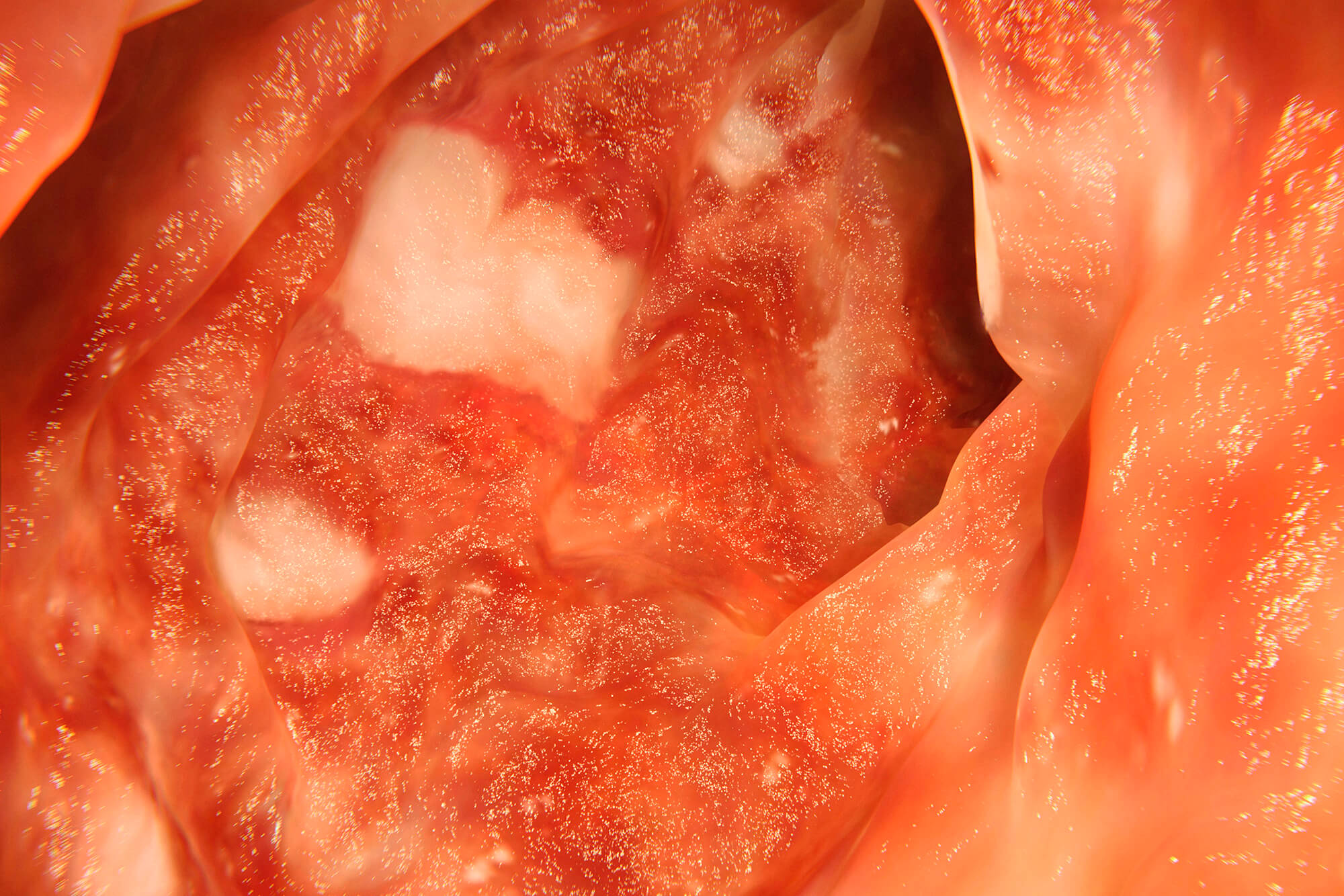 A colon affected by ulcerative colitis.