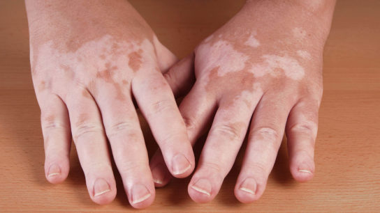 Many patients with vitiligo undergo multiple courses of phototherapy, which may raise concerns about their risk of photocarcinogenesis.